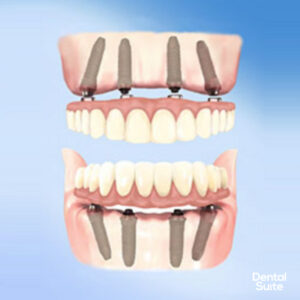 Teeth in a Day Implants